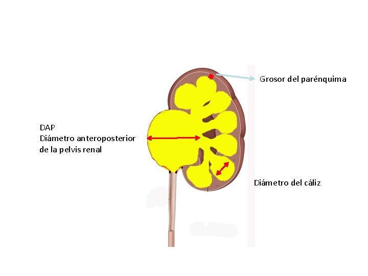 Grosor del parénquima DAP Diámetro anteroposterior de la pelvis renal Diámetro del cáliz 