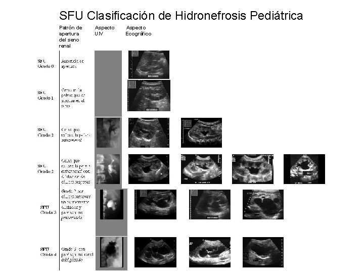 SFU Clasificación de Hidronefrosis Pediátrica Patrón de apertura del seno renal Aspecto UIV Aspecto