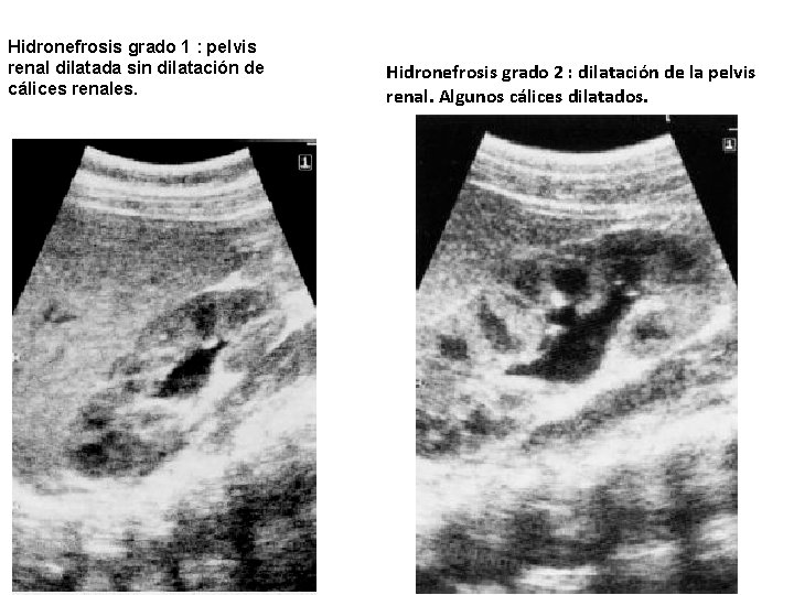 Hidronefrosis grado 1 : pelvis renal dilatada sin dilatación de cálices renales. Hidronefrosis grado