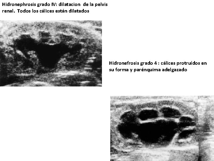  Hidronephrosis grado IV: dilatacion de la pelvis renal. Todos los cálices están dilatados