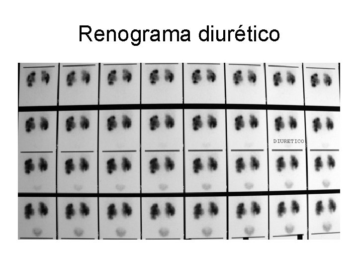 Renograma diurético 