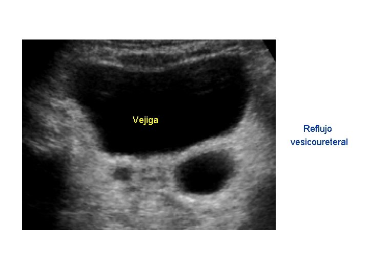 Vejiga Reflujo vesicoureteral 