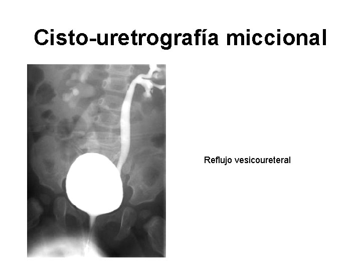Cisto-uretrografía miccional Reflujo vesicoureteral 