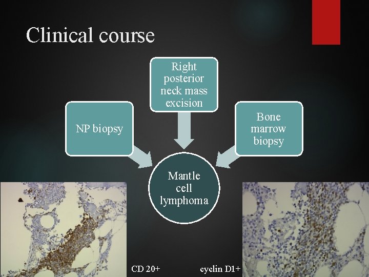 Clinical course Right posterior neck mass excision Bone marrow biopsy NP biopsy Mantle cell