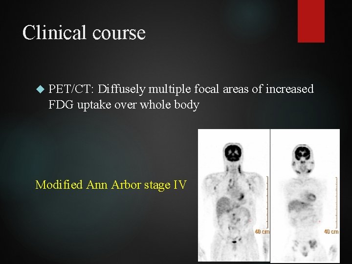 Clinical course PET/CT: Diffusely multiple focal areas of increased FDG uptake over whole body