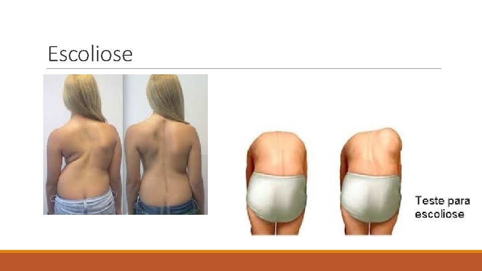 Escoliose 