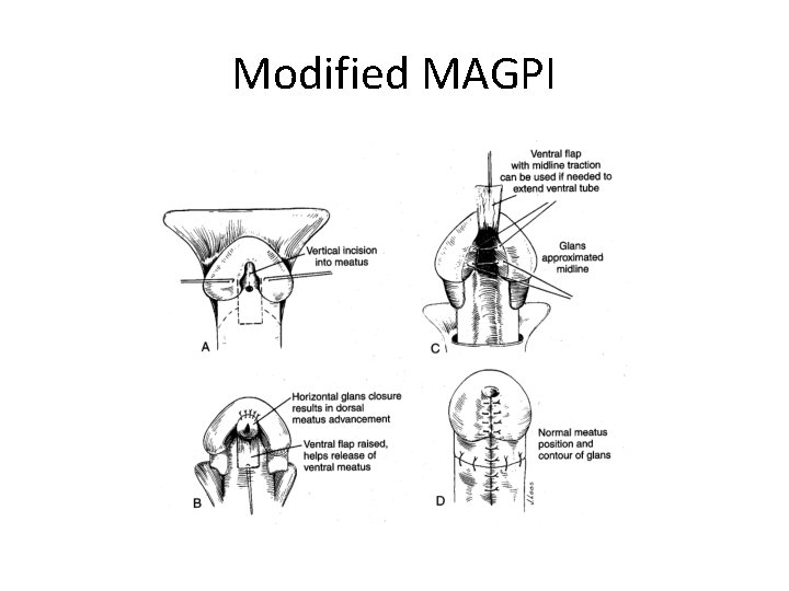 Modified MAGPI 