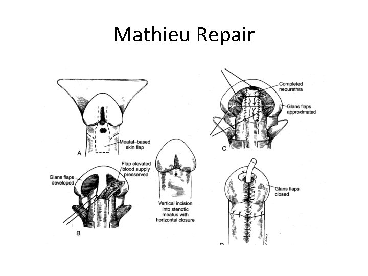Mathieu Repair 