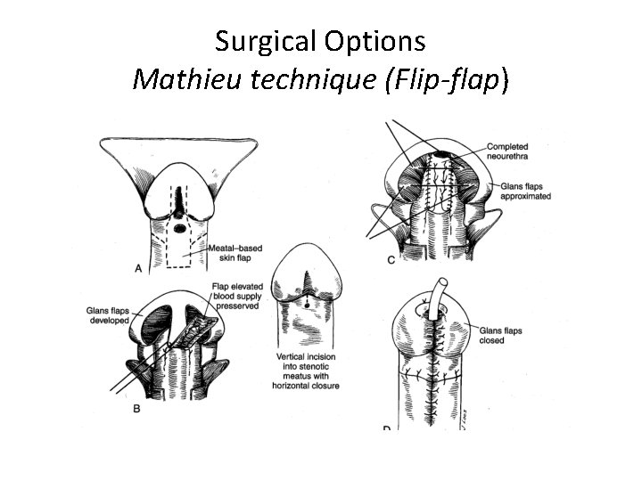 Surgical Options Mathieu technique (Flip-flap) 