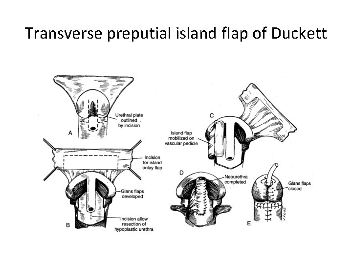 Transverse preputial island flap of Duckett 