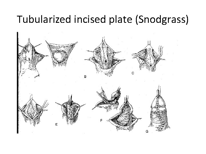 Tubularized incised plate (Snodgrass) 