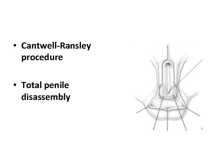  • Cantwell-Ransley procedure • Total penile disassembly 