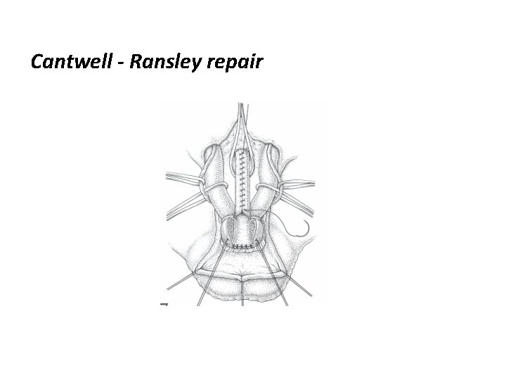 Cantwell - Ransley repair 