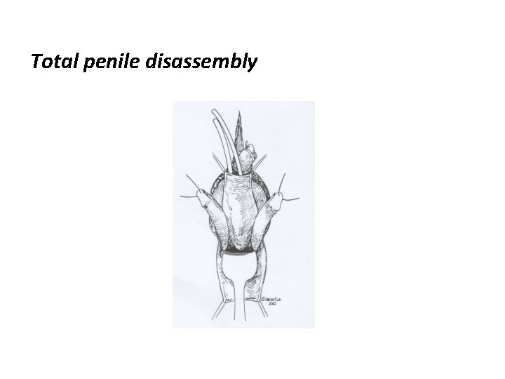 Total penile disassembly 