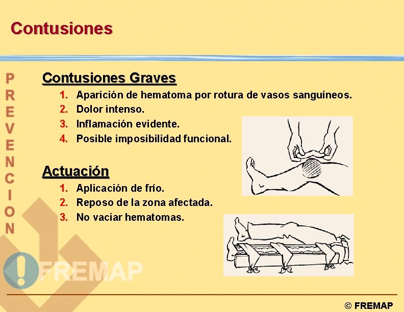 Contusiones Graves 1. 2. 3. 4. Aparición de hematoma por rotura de vasos sanguíneos.