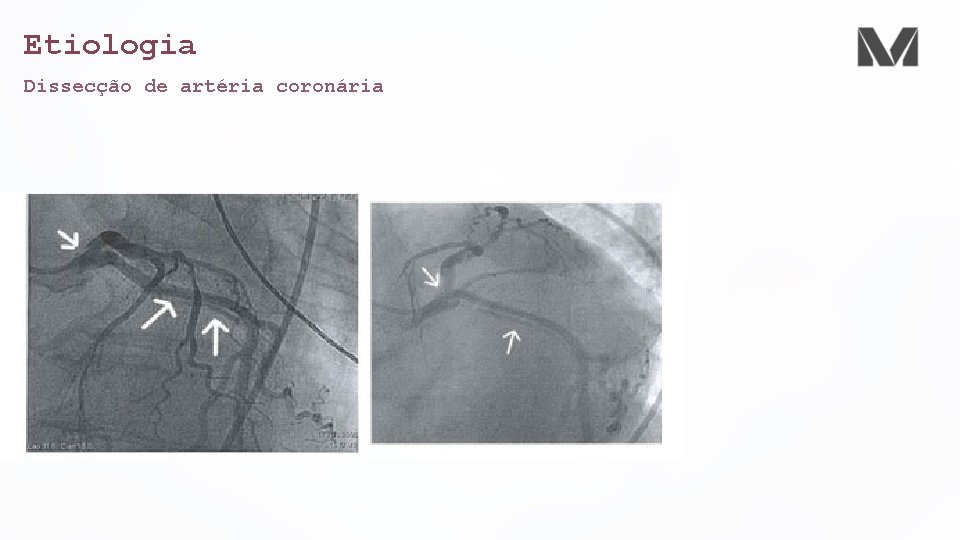Sndrome Coronariana Aguda Cardiologia Dr Cristian Souza Cardiologista