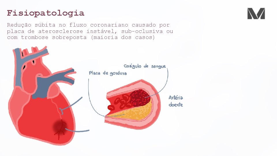 Sndrome Coronariana Aguda Cardiologia Dr Cristian Souza Cardiologista