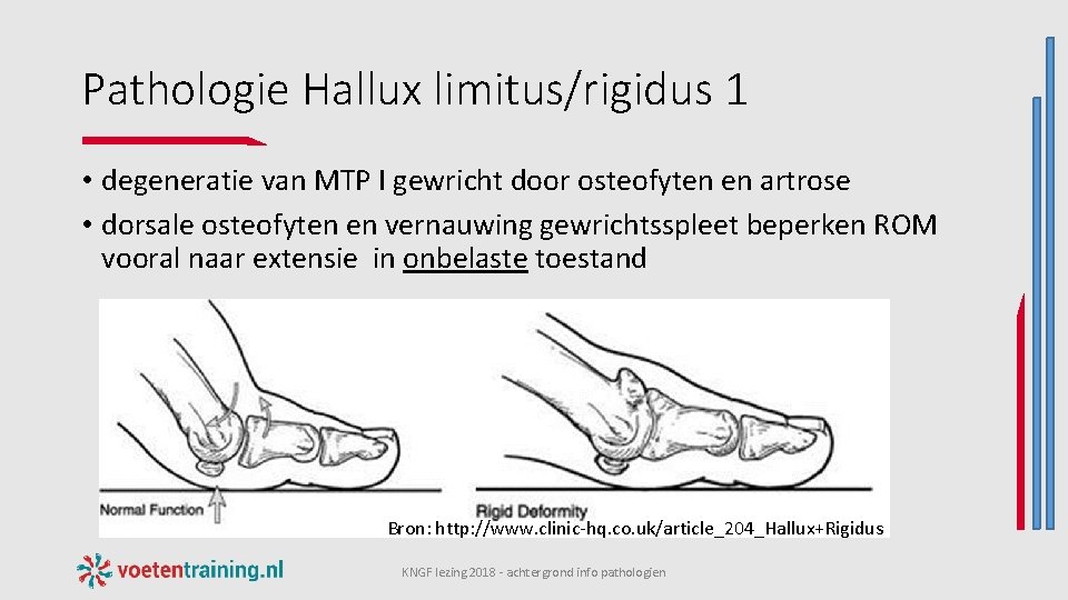 Pathologie Hallux limitus/rigidus 1 • degeneratie van MTP I gewricht door osteofyten en artrose
