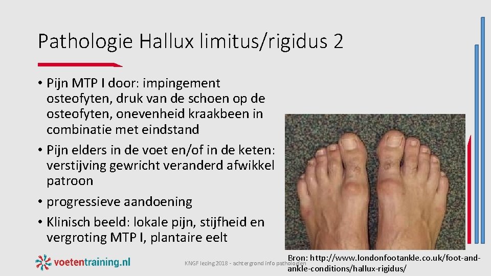 Pathologie Hallux limitus/rigidus 2 • Pijn MTP I door: impingement osteofyten, druk van de
