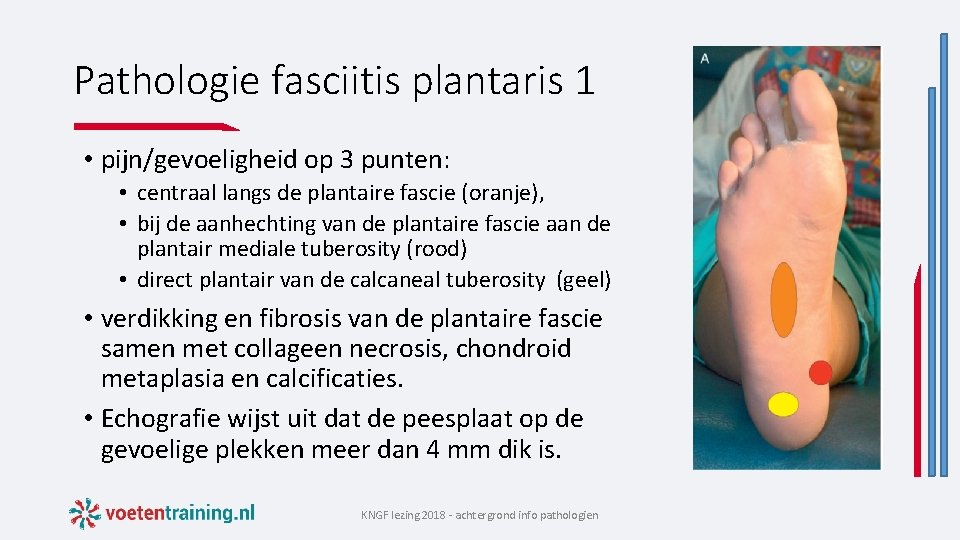 Pathologie fasciitis plantaris 1 • pijn/gevoeligheid op 3 punten: • centraal langs de plantaire