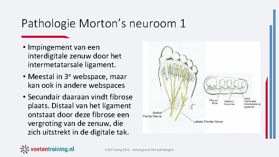 Pathologie Morton’s neuroom 1 • Impingement van een interdigitale zenuw door het intermetatarsale ligament.