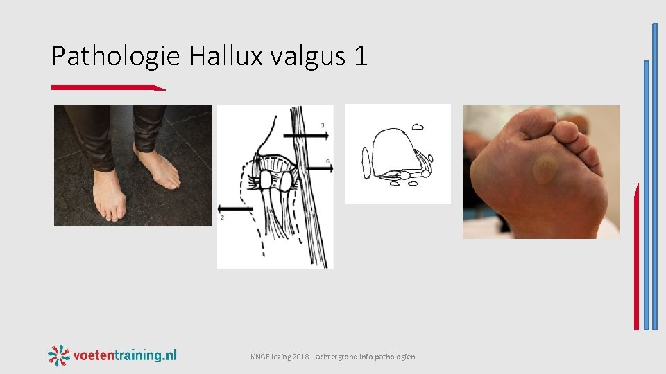 Pathologie Hallux valgus 1 KNGF lezing 2018 - achtergrond info pathologien 