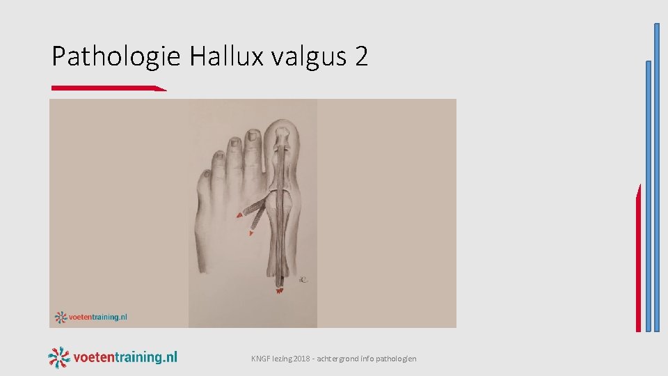 Pathologie Hallux valgus 2 KNGF lezing 2018 - achtergrond info pathologien 