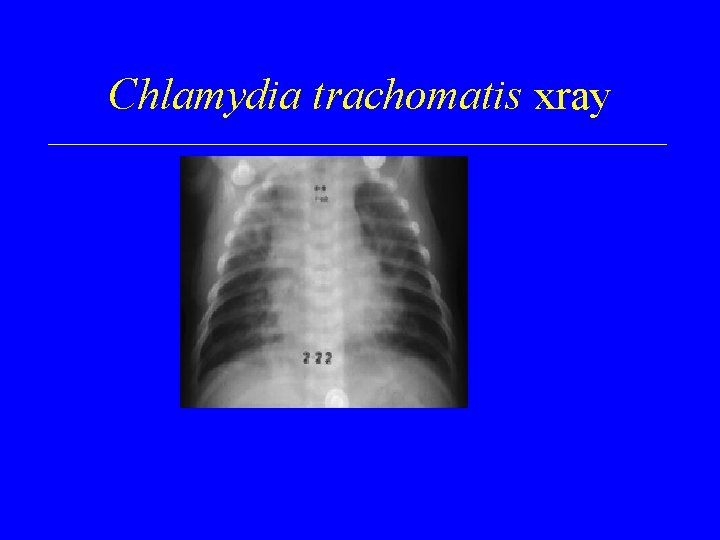 Chlamydia trachomatis xray 