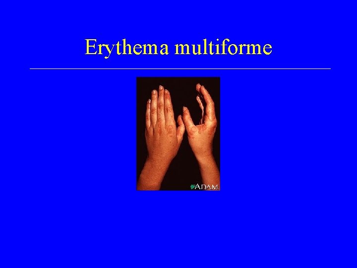 Erythema multiforme 