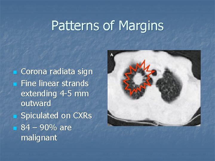 The Solitary Pulmonary Nodule Suneel S Kumar MD