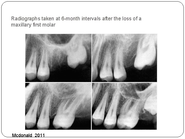 Radiographs taken at 6 -month intervals after the loss of a maxillary first molar