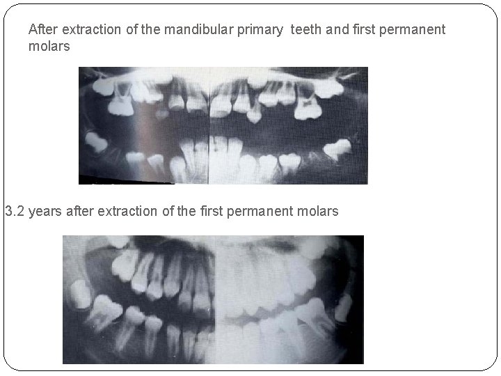 After extraction of the mandibular primary teeth and first permanent molars 3. 2 years