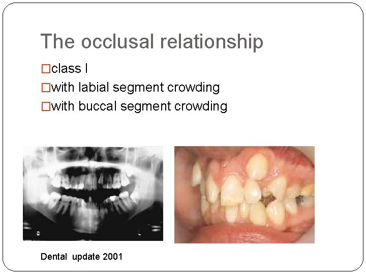 The occlusal relationship �class I �with labial segment crowding �with buccal segment crowding Dental