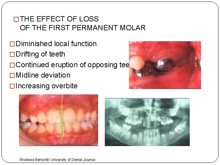 � THE EFFECT OF LOSS OF THE FIRST PERMANENT MOLAR � Diminished local function