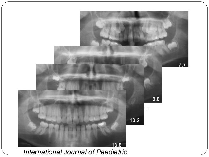 7. 7 8. 8 7, 7 10. 2 13. 8 International Journal of Paediatric