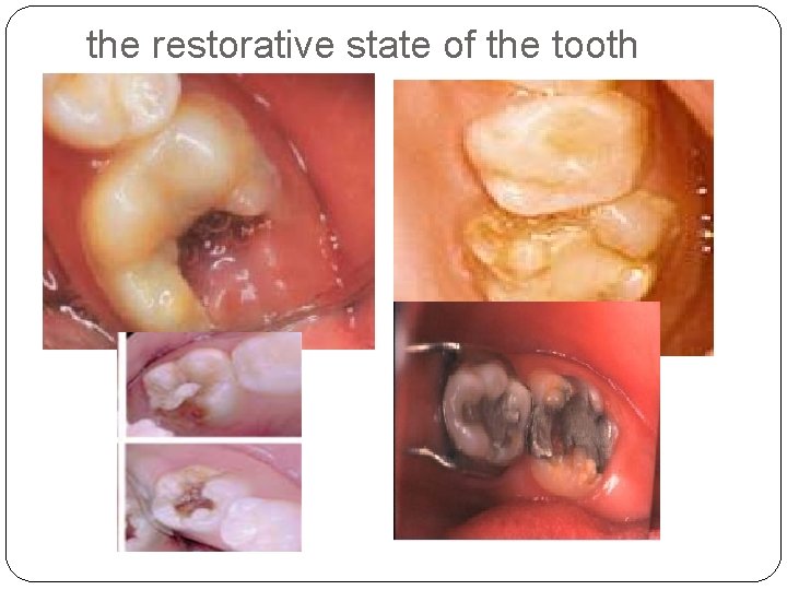 the restorative state of the tooth 