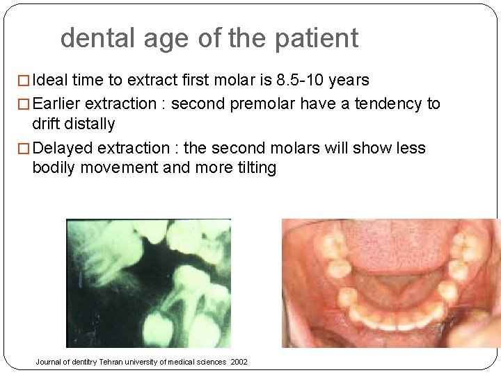 dental age of the patient � Ideal time to extract first molar is 8.