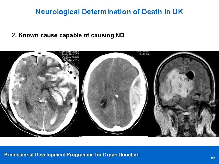 Neurological Determination of Death in UK 2. Known cause capable of causing ND Professional