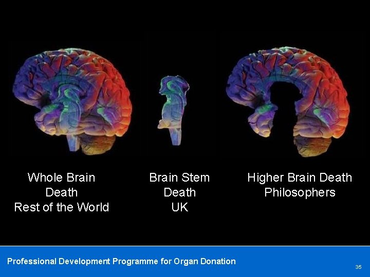 Whole Brain Death Rest of the World Brain Stem Death UK Professional Development Programme