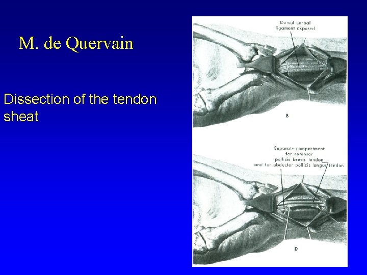 M. de Quervain Dissection of the tendon sheat 