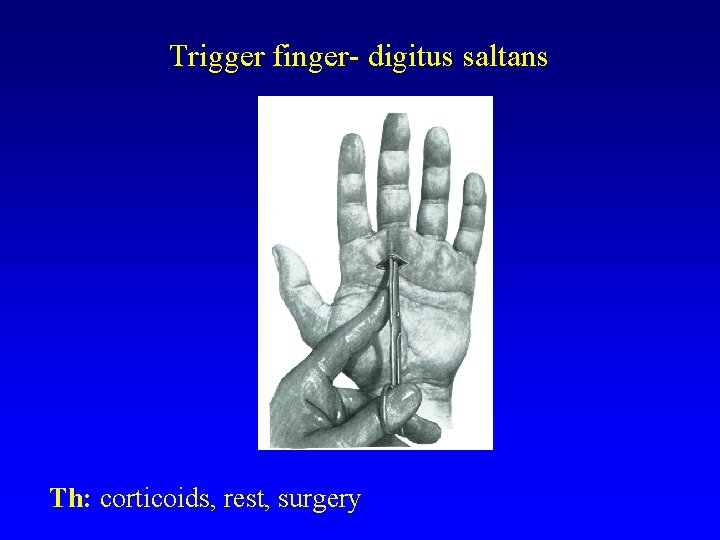 Trigger finger- digitus saltans Th: corticoids, rest, surgery 