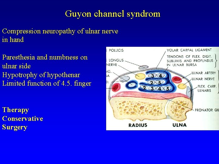 Guyon channel syndrom Compression neuropathy of ulnar nerve in hand Paresthesia and numbness on