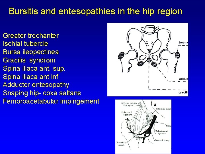 Bursitis and entesopathies in the hip region Greater trochanter Ischial tubercle Bursa ileopectinea Gracilis