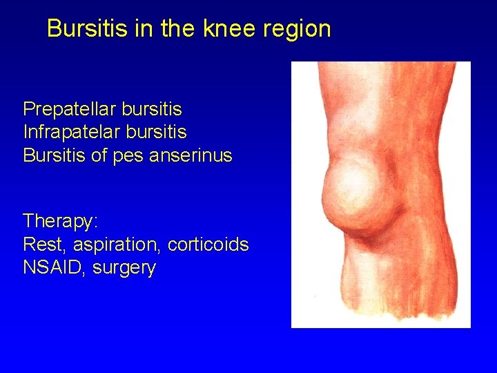 Bursitis in the knee region Prepatellar bursitis Infrapatelar bursitis Bursitis of pes anserinus Therapy: