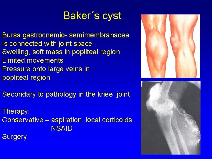 Baker´s cyst Bursa gastrocnemio- semimembranacea Is connected with joint space Swelling, soft mass in