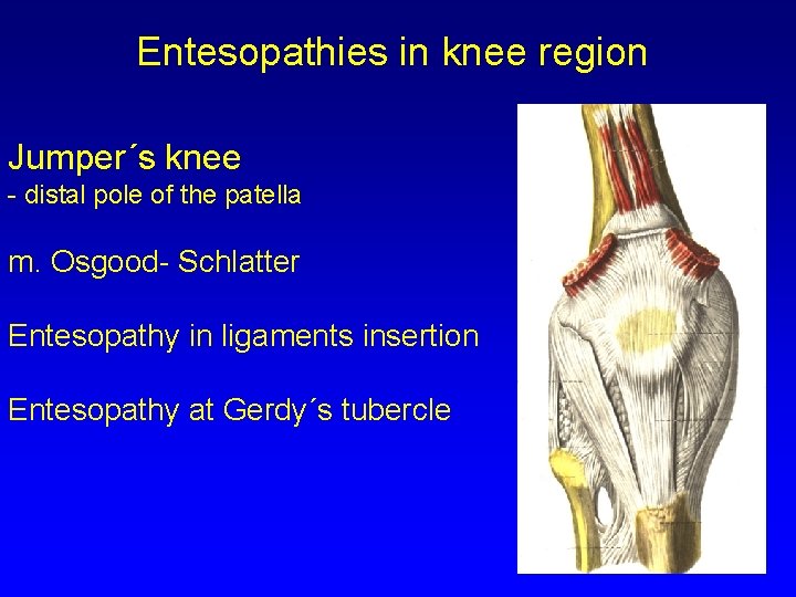 Entesopathies in knee region Jumper´s knee - distal pole of the patella m. Osgood-