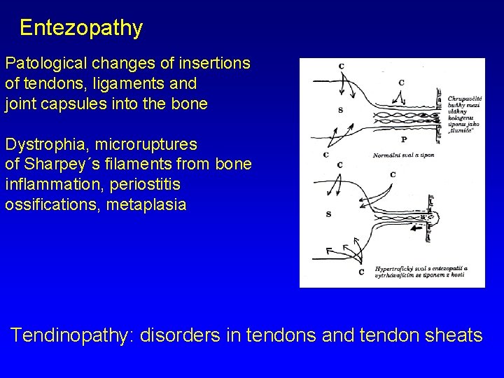 Entezopathy Patological changes of insertions of tendons, ligaments and joint capsules into the bone