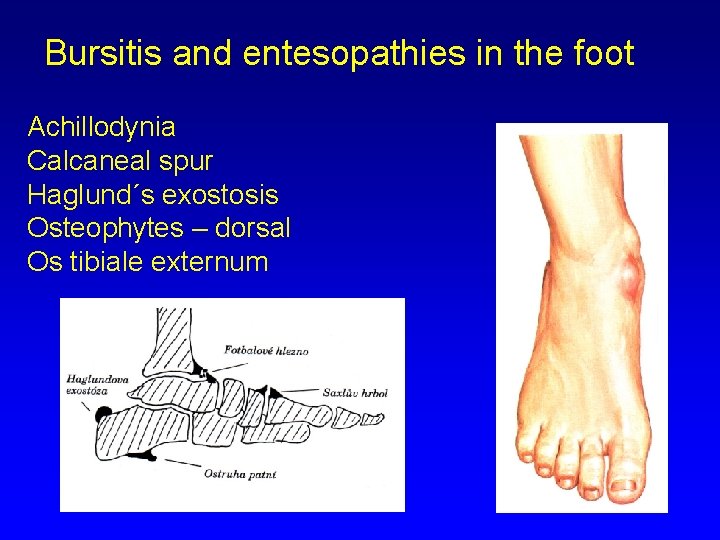 Bursitis and entesopathies in the foot Achillodynia Calcaneal spur Haglund´s exostosis Osteophytes – dorsal
