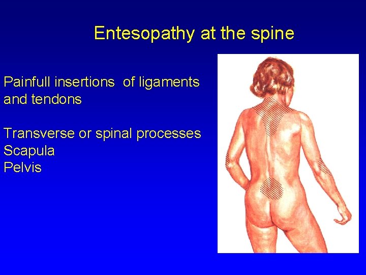 Entesopathy at the spine Painfull insertions of ligaments and tendons Transverse or spinal processes