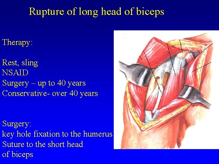 Rupture of long head of biceps Therapy: Rest, sling NSAID Surgery – up to
